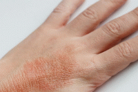 راهکارهای درمانی اگزمای پوست/۲۰ درصد اگزماهای تماسی از نوع آلرژیک هستند