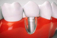 بهترین سن برای ایمپلنت دندانی چه زمانی است؟